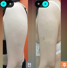  팔뚝 람스 한달차 멍통증, 멍크림 후기 찐내돈내산