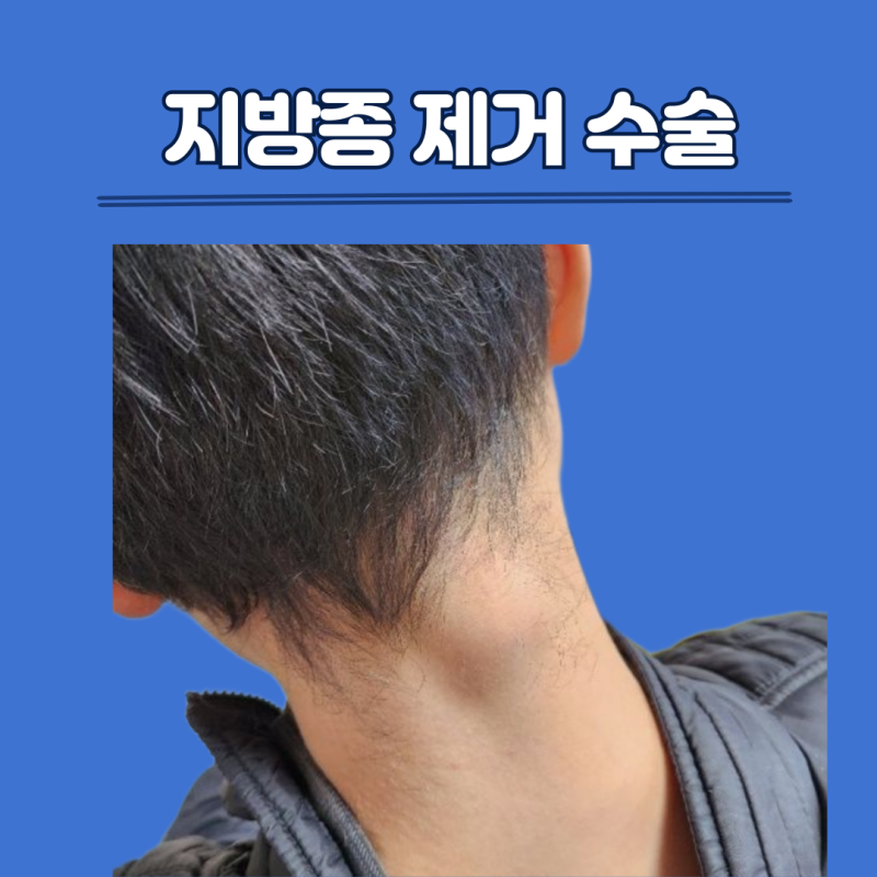 동탄송도항외과 지방종제거 수술후기, 비용, 보험금청구 서류