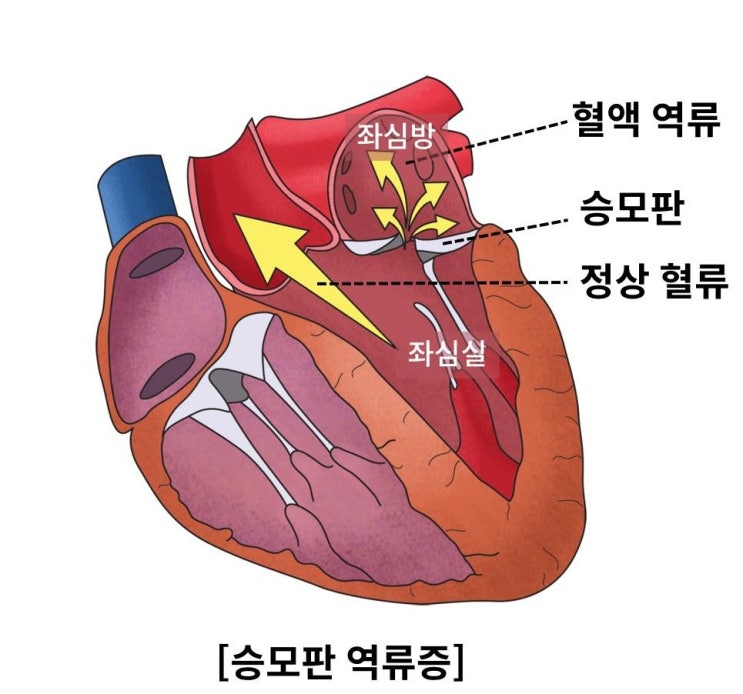 "심장 내 승모판 역류증, 성별 따라 수술 시점 달라져야"