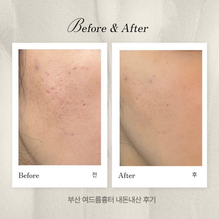  부산흉터치료ㅣ여드름흉터 한의원 패인흉터치료 새살침 내돈내산 후기