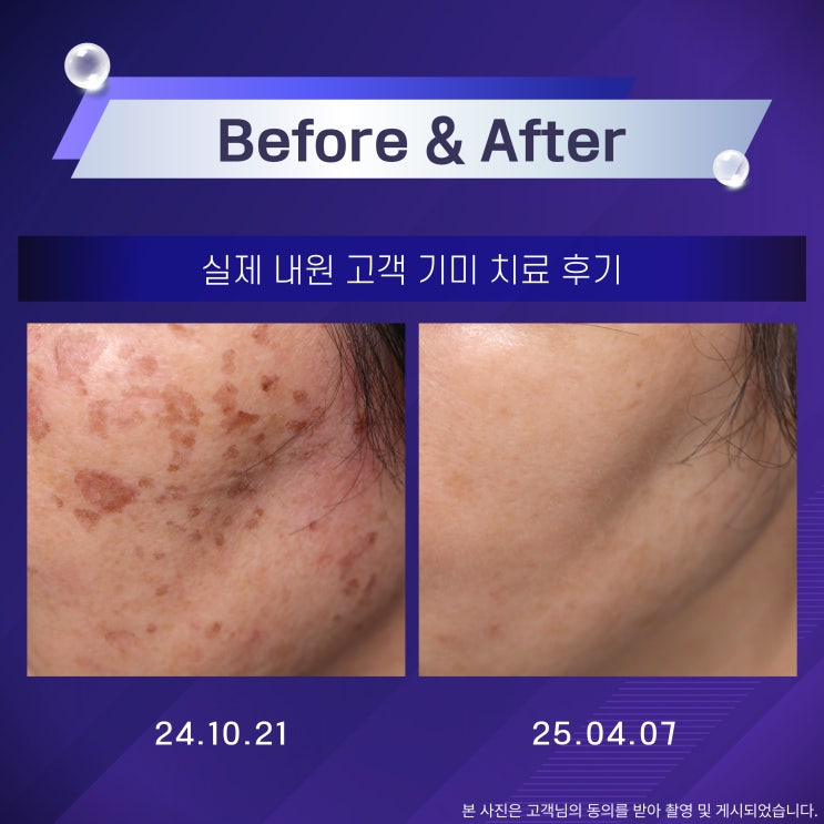  연신내역피부과 기미색소를 없애고 싶다면? 실제로 효과 본 피부과 치료법 알려드릴게요