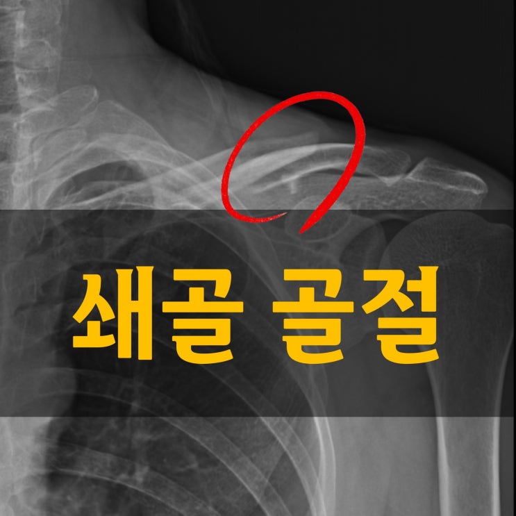  쇄골 골절 수술 후 회복식단과 한약복용
