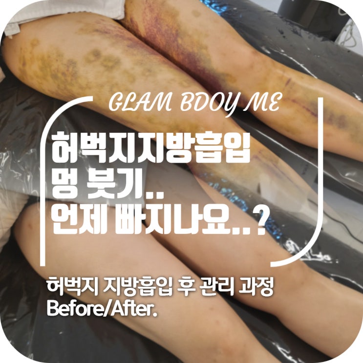  허벅지 지방흡입 후 붓기는 언제 빠지나요?