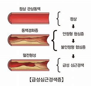 급성 심근 경색(MI)