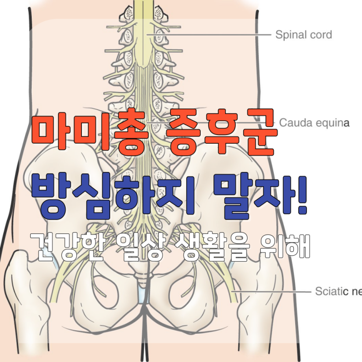  마미총 증후군(Cauda Equina Syndrome) 허리디스크보다 더 위험한 이유