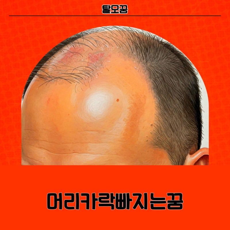 탈모꿈 다양하게 머리카락빠지는 상황별 꿈 풀이