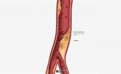 급성 관상동맥 증후군에 대한 혈관재생술(Revascularization) 개요