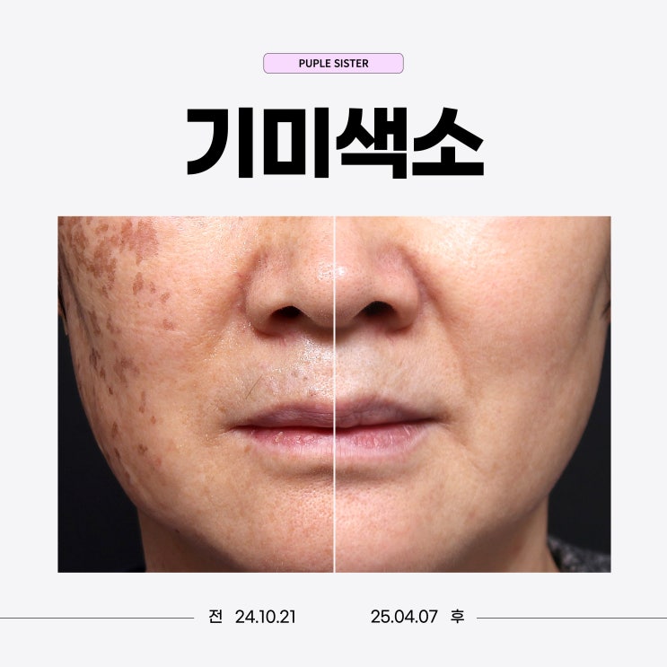  용산피부과, 출산 후 피부가 예전 같지 않아서 받은 기미치료 후기