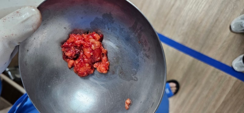 지방종 발견.. 그리고 지방종 제거 수술까지 (부산)