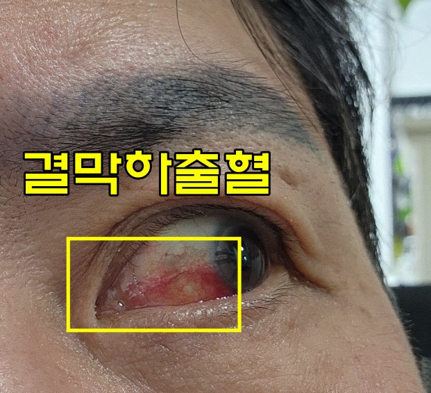  결막하 출혈 뜻, 눈에 실핏줄 터졌을 때 원인 및 증상