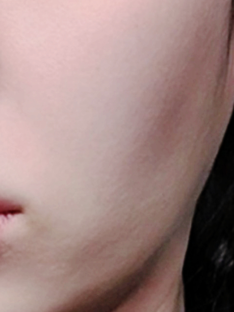  울쎄라, 리프팅 효과는 높이고 부작용은 줄이고 싶나요? '이것' 확인해보세요.