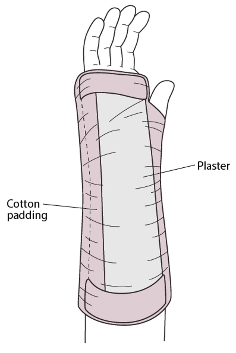 [간호사 공부] 정형외과 보조기 스플린트(Splint)의 종류에 대해 알아봅시다. : 네이버 블로그