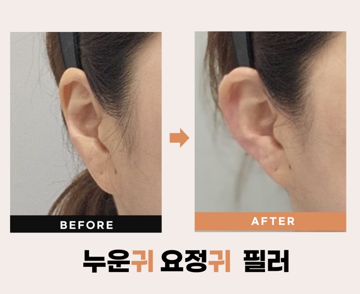  강남역 귀필러 누운귀,요정귀 내얼굴에 딱 맞는 모양으로 변신한  솔직리뷰
