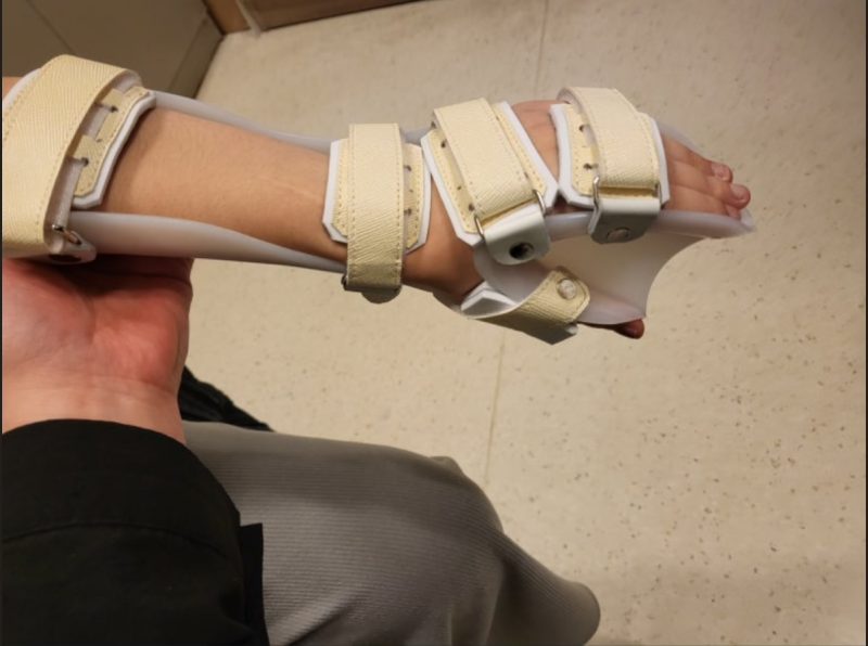 [간호사 공부] 정형외과 보조기 스플린트(Splint)의 종류에 대해 알아봅시다. : 네이버 블로그