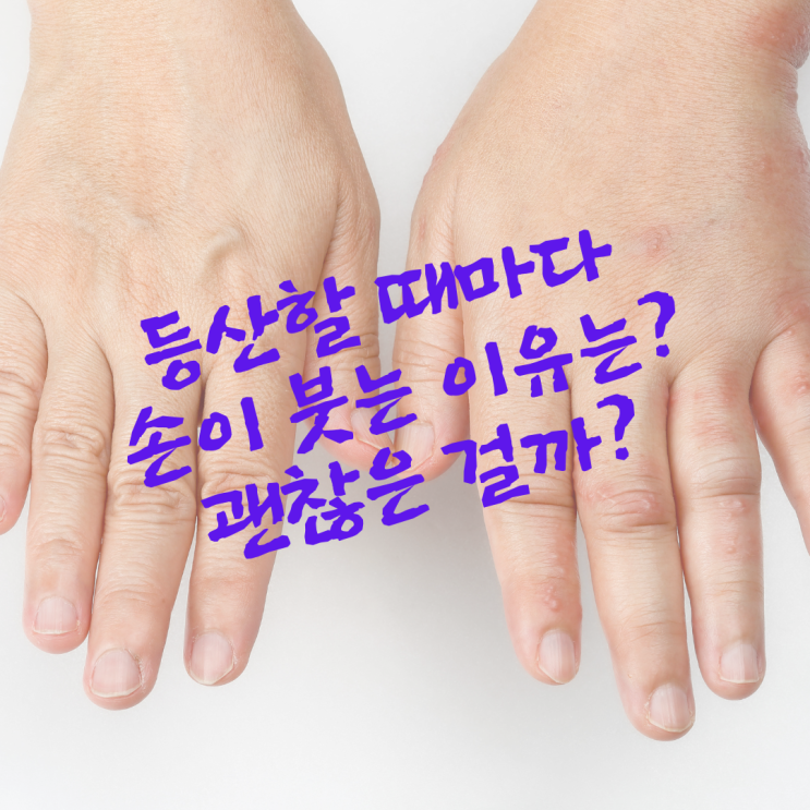  등산할 때마다 손이 붓는 이유는? 괜찮은 걸까?