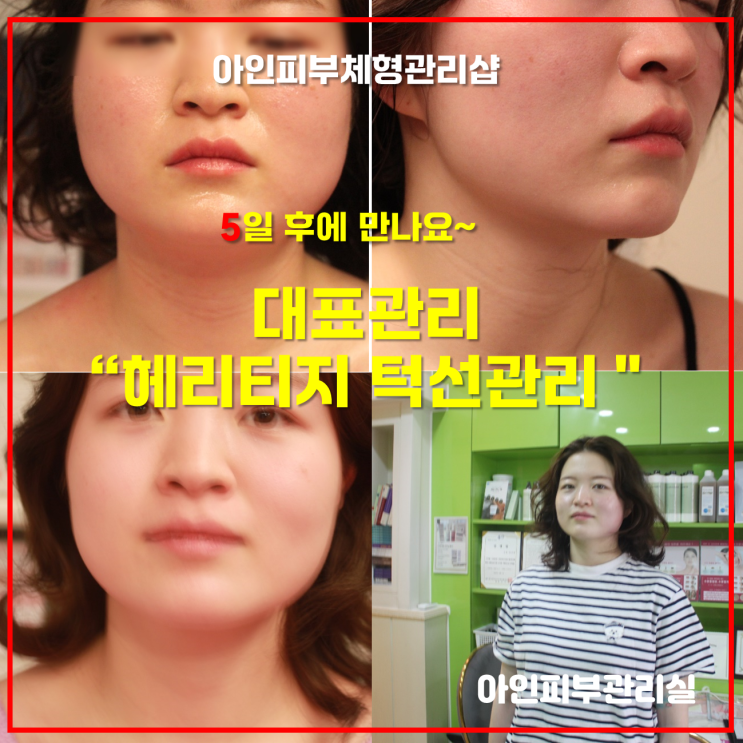 천안피부관리 얼굴이 예뻐지는과정 신부동 얼굴 윤곽관리 사각턱 턱선관리 및 변화과정