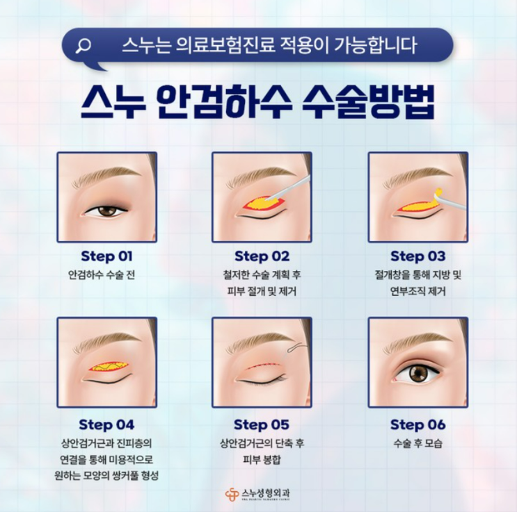 청담 안검하수, 눈매교정 눈수술 후 회복시간