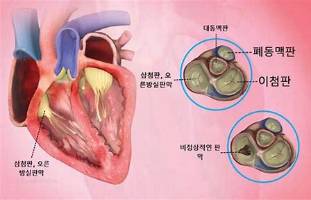 삼첨판 역류(삼첨판 기능 부전; 삼첨판 무능력)