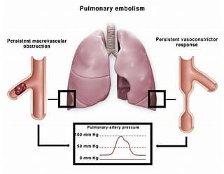 폐동맥 역류 및 협착증 Pulmonic Valve ,Stenosis )