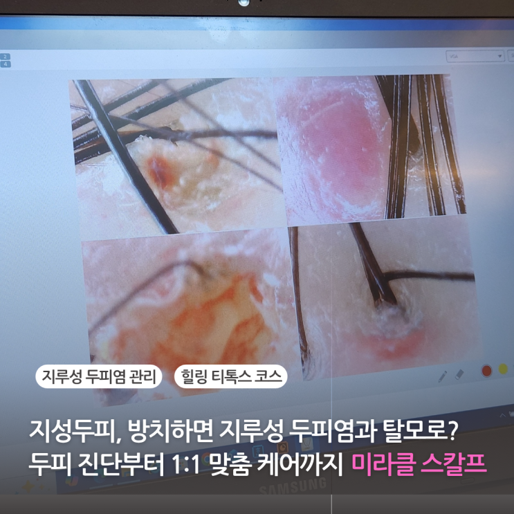지성두피 방치하면 지루성 두피염과 탈모로 가는 지름길 두피힐링센터에서 1:1 맞춤 두피 케어 탈모 관리 받은 솔직 후기