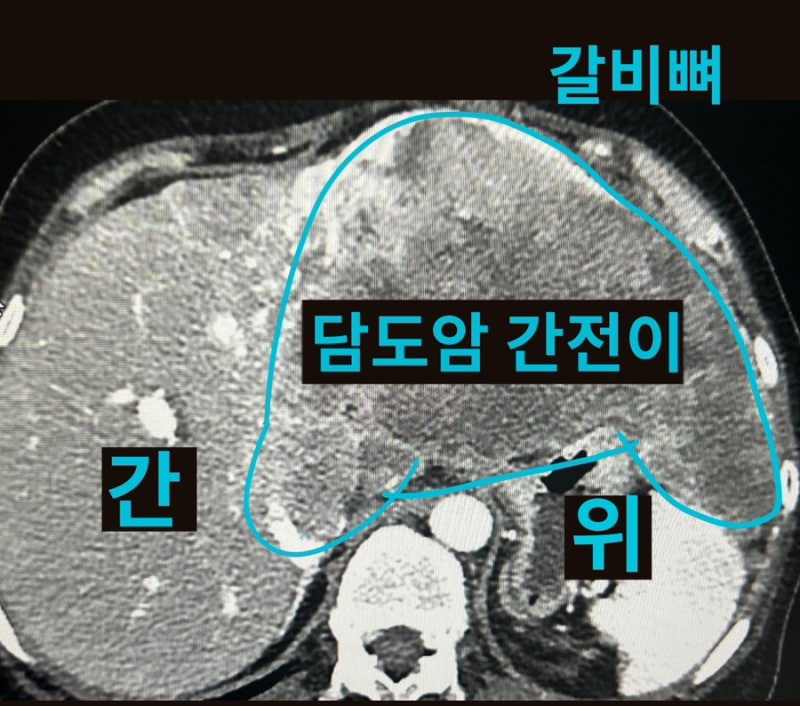 담도암 간전이