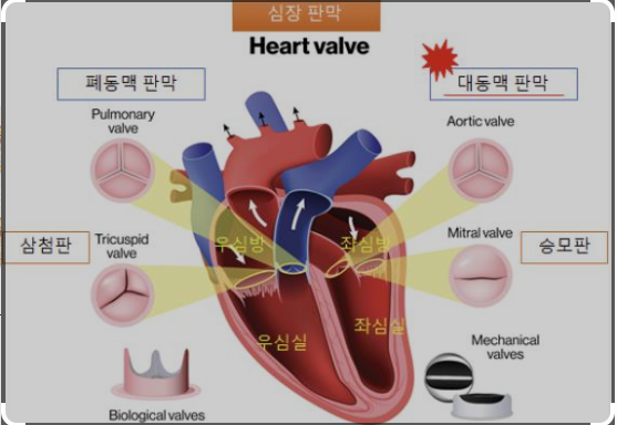 심장판막 수술과 시술(TAVI) 차이와 비용, 어떤 치료가 내게 ....