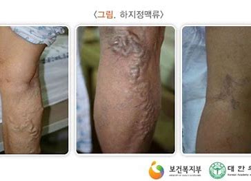 말초 정맥 질환의 모든 것 무엇인가?!