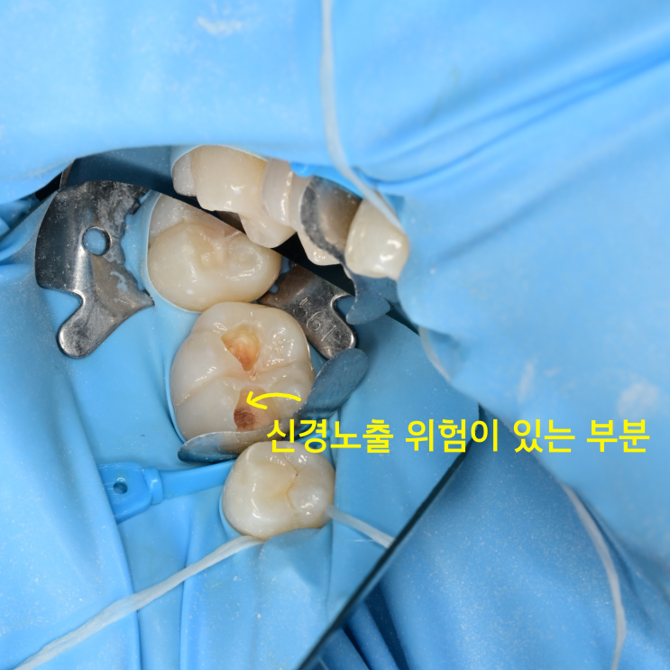  "신경치료는 피하고 싶어요" 13세 아이의 인접면 충치, 최소삭제 레진 빌드업 치료 사례
