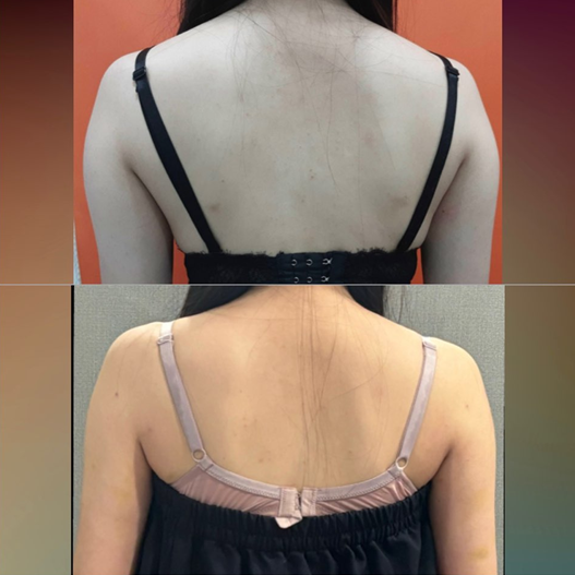  팔뚝 람스 5주차 멍소멸, 뭉침, 후관리추가 후기 찐내돈내산