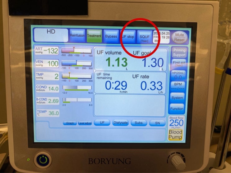  SQUF는 Slow QUF : Slow Ultrafiltration 근데 Q는 왜 있는 거야???