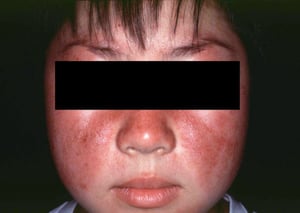 전신성 홍반성 루푸스(SLE)(파종성 홍반성 루푸스)란?!