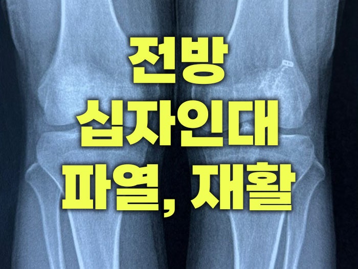 전방 십자인대 파열 재활, 수술 전에도 해야하는데