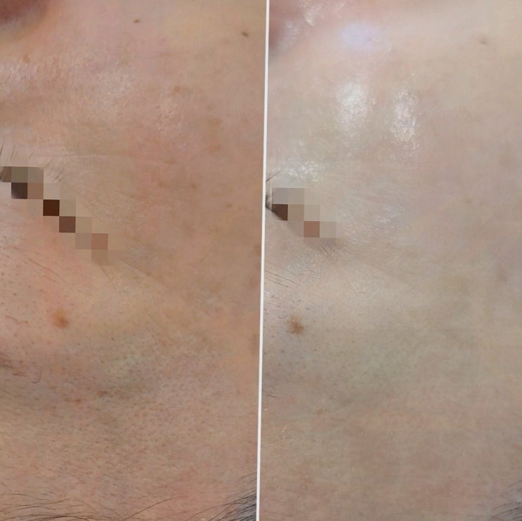  아비에 피부&왁싱 대전점, 결혼식을 앞둔 완벽한 피부 관리 대전피부관리
