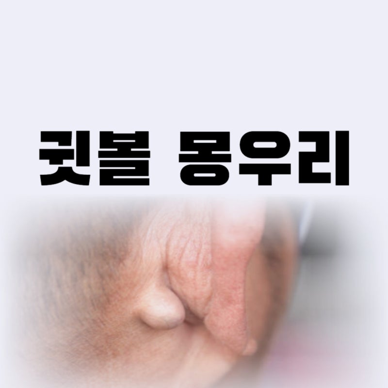 귓볼 몽우리 통증 병원 언제? 어디로? 왜? 놓치지 마세요