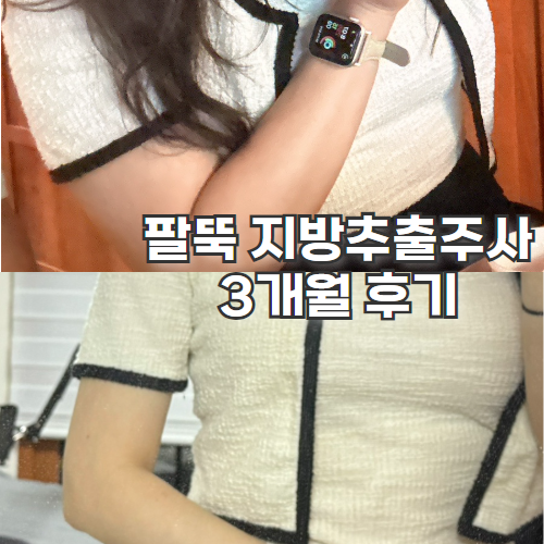  효과 좋아서 찐만족 팔뚝 지방추출주사 3개월차 비교 후기