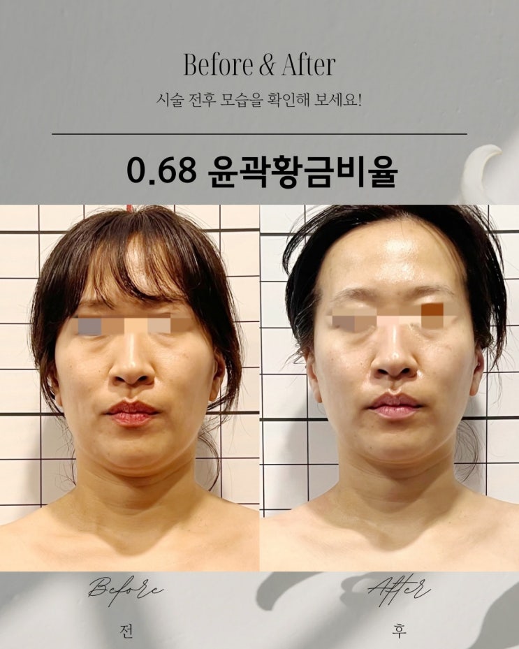  동래피부관리 [윤곽관리] 팔자주름, 눈가주름, 광대축소까지! 전후 사진으로 확인하세요