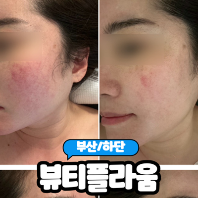  [부산/하단] 예민한 피부, 홍조피부 진정관리 받고온 하단에스테틱 "뷰티플라움" 내돈내산