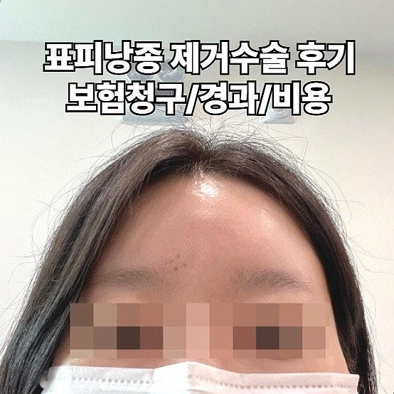  대구 표피낭종 제거 수술 후기 비용 흉터 D239 보험청구
