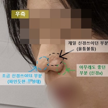 [피부과] 비후성 반흔 6회 치료 전후/ 구진성 흉터 내돈내산 1달 후기