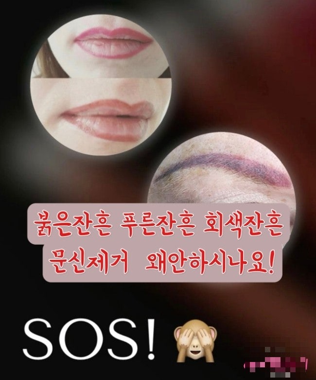  전주눈썹 붉은잔흔 푸른잔흔 문신제거 안하시는분들은.. 후기