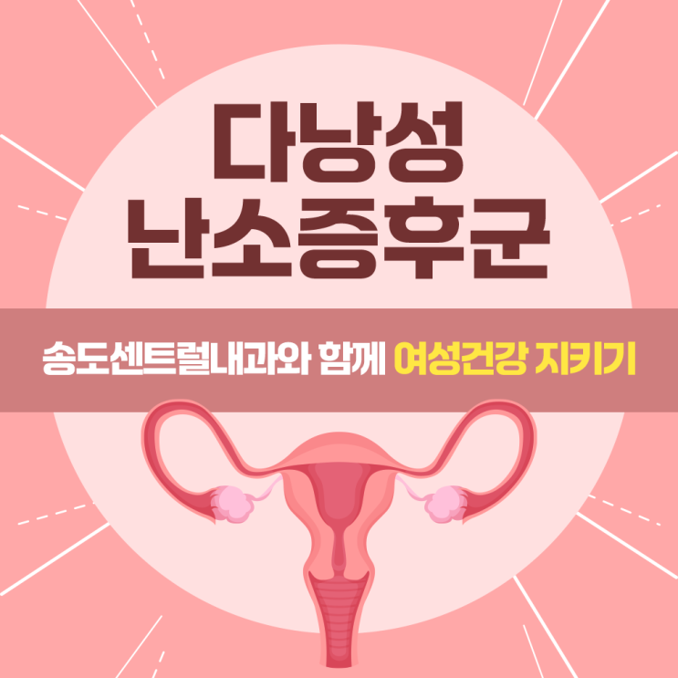  송도건강검진 다낭성난소증후군이란? 원인과 증상, 치료법 총정리
