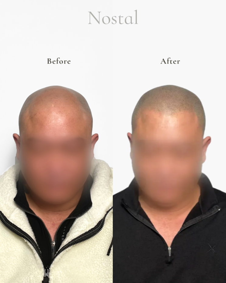  대전탈모커버, 두피문신으로 고민 해결