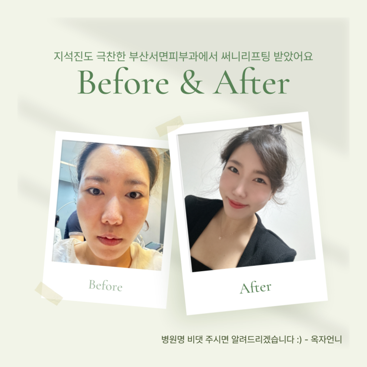  지석진도 받은 부산서면피부과에서 써니리프팅 받았어요
