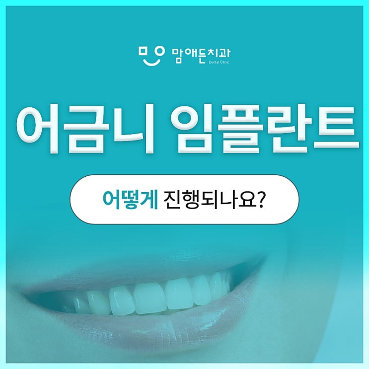  어금니 발치후 임플란트 기간 및 과정 확인