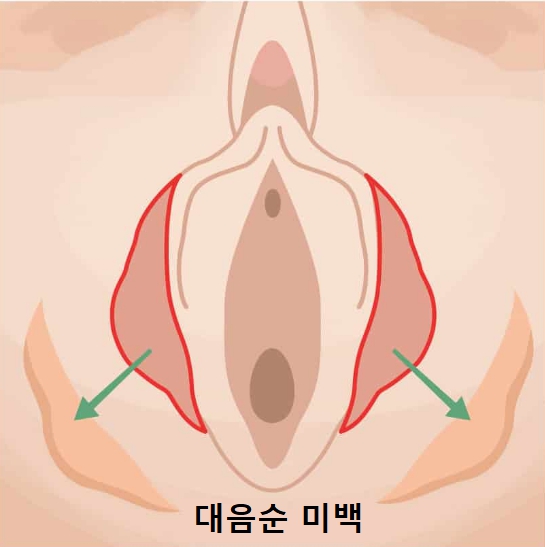  대음순 미백 레이저로 완성하는 프라이빗 리뉴얼