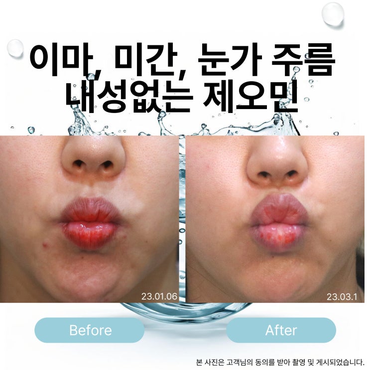 은평구 피부과 추천｜스킨보톡스 vs 일반보톡스 차이 알려드려요