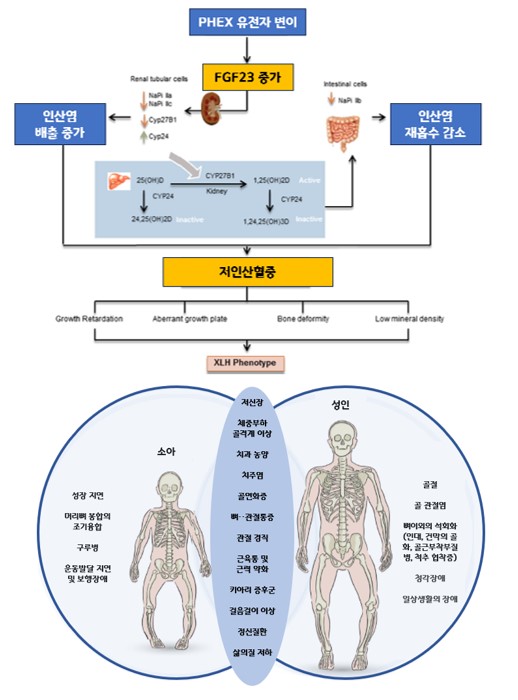 인산염 농도 장애 신부전증