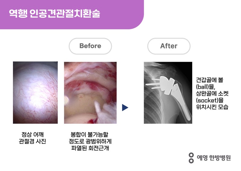 어깨인공관절수술(TSA,RTSA),인공견관절치환술,역행 인공견관절치환술, 회전근개파열 수술 종류/어깨 수술 재활-수지 예영한방 ...