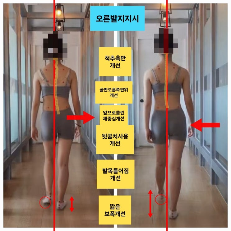  동래 온천동 체형교정, 한달 후 보행+자세교정 비포에프터 변화