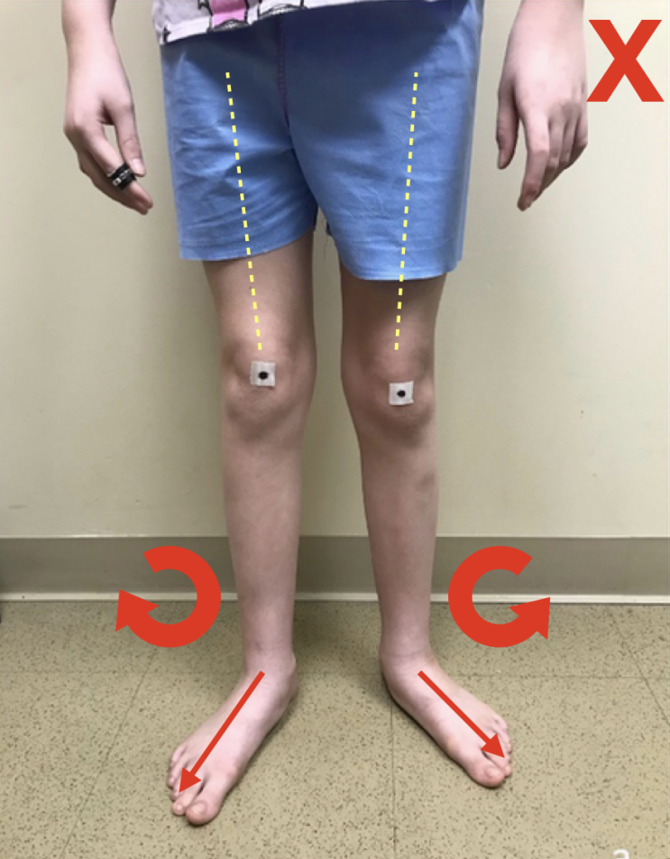 수원PT 무릎 아플때 체크해야 할 것 정강이 비틀림